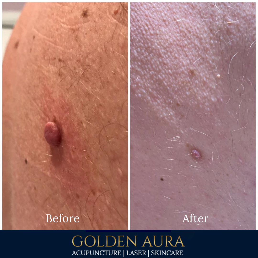 Copy of Cryotherapy.png