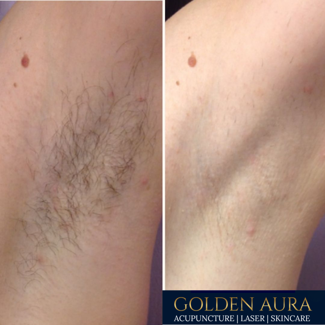 Underarm LHR before & after2.png