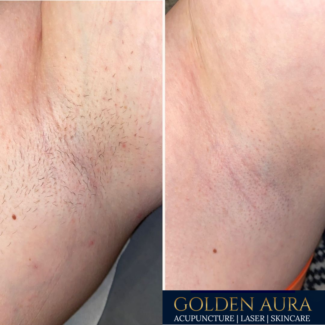 Underarm LHR before and after.png