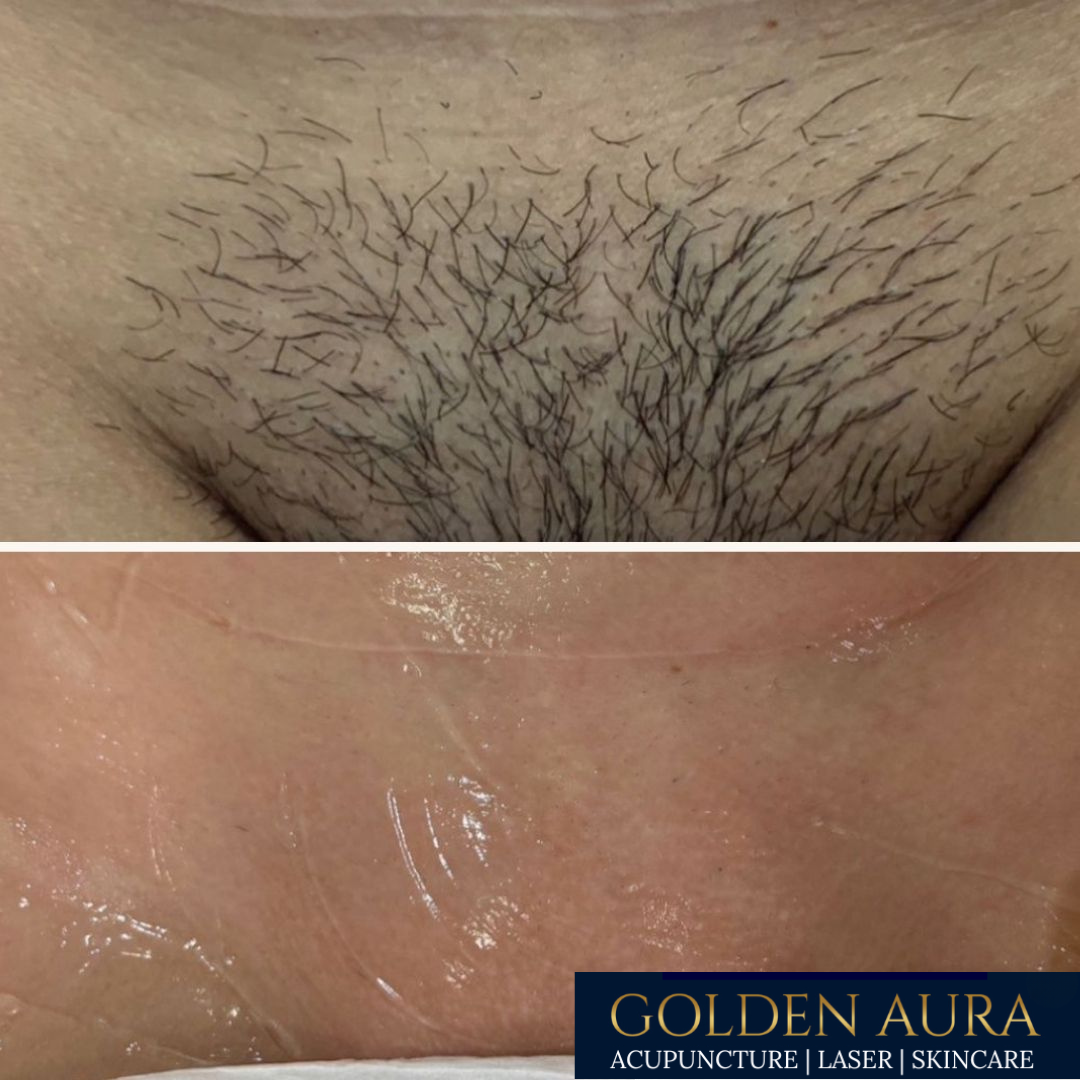 Hollywood LHR before & after.png