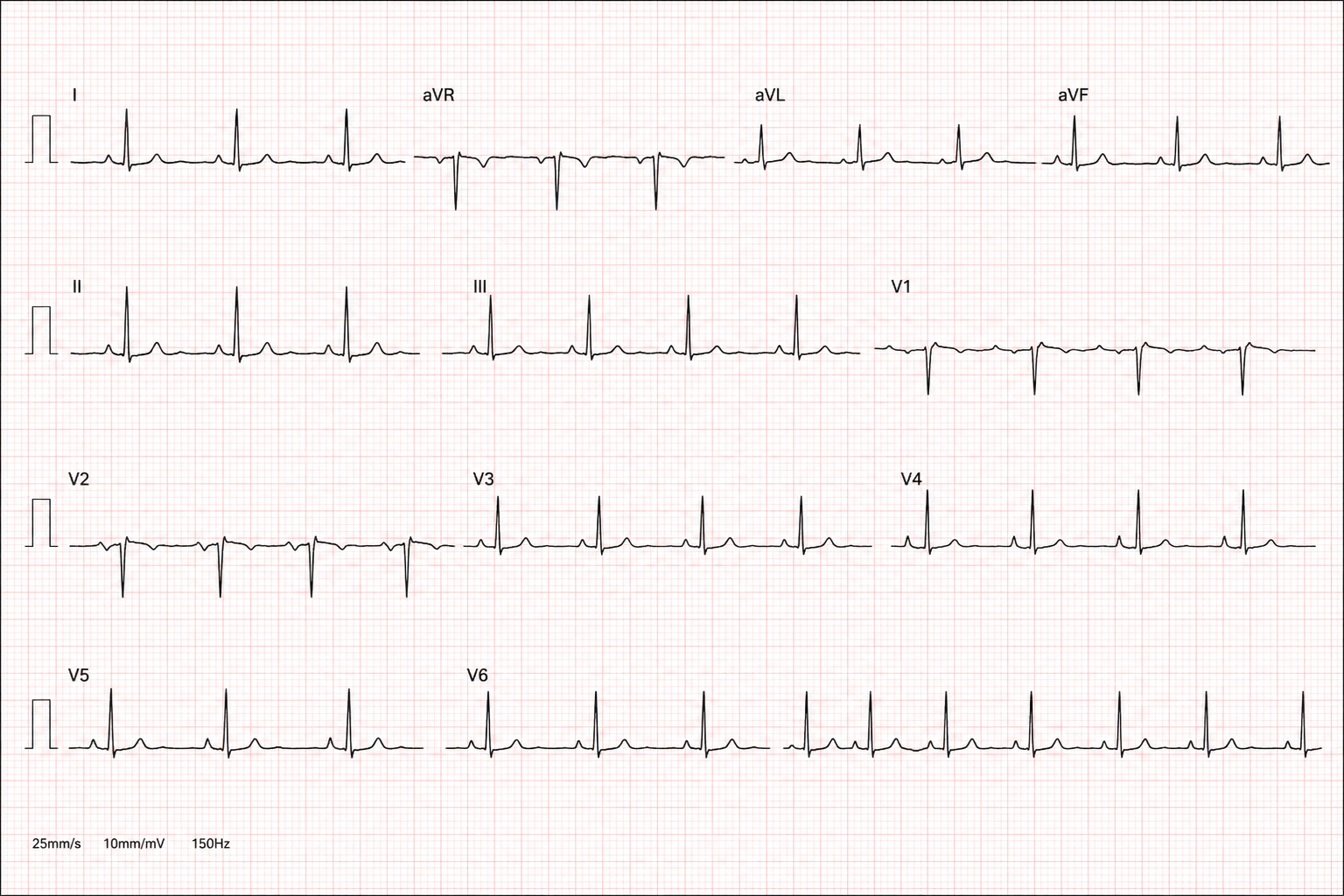ECG
