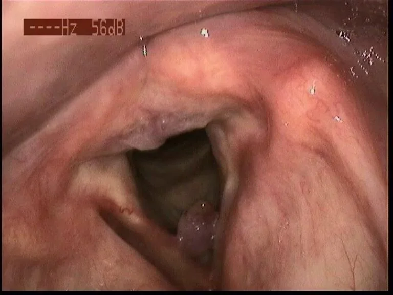 Stimmlippenpolyp