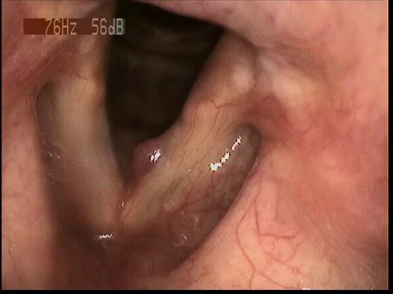 hämorragischer Stimmlippenpolyp
