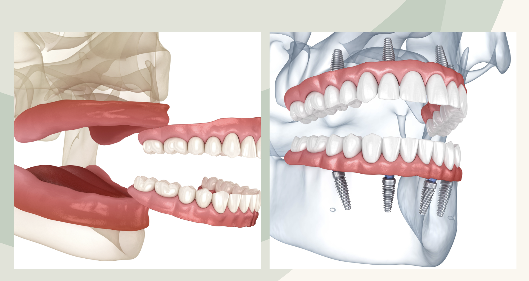 Dentures vs Dental Implants: Why Dental Implants Are the Better Choice