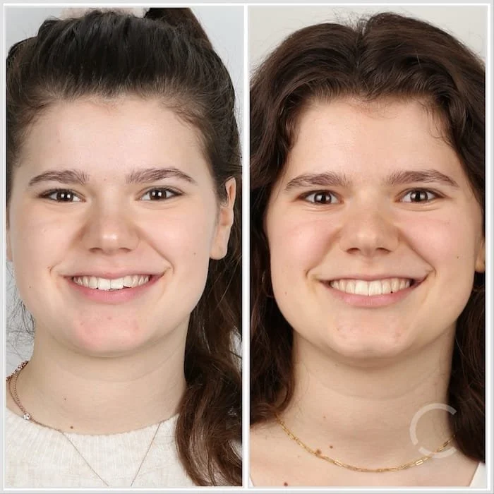 Vorher-Nachher-Bild einer jungen Patientin mit verbesserter Zahnstellung und natürlichem Lächeln