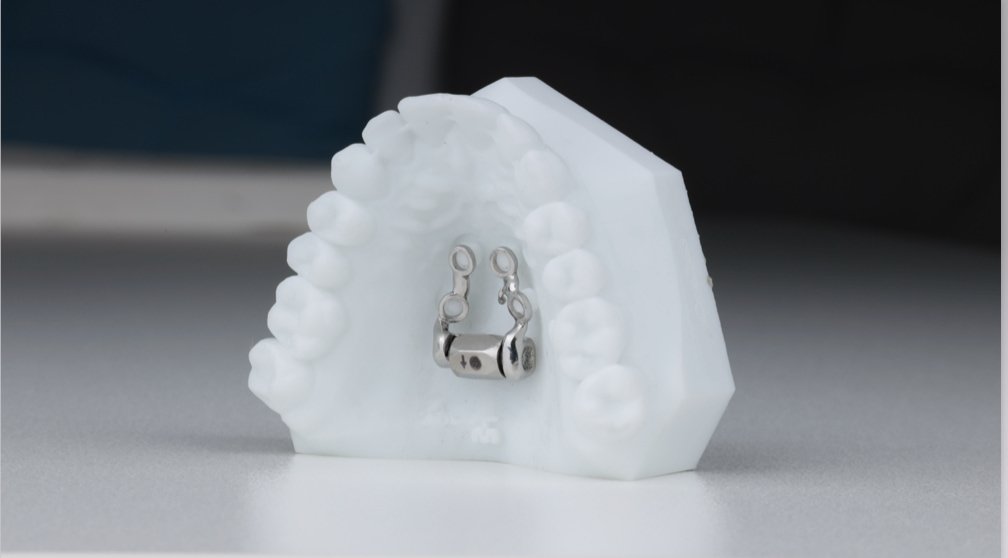 Expander auf 4 Mini-Implantaten