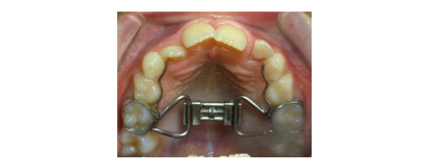 Rapid Palatal Expansion Appliance