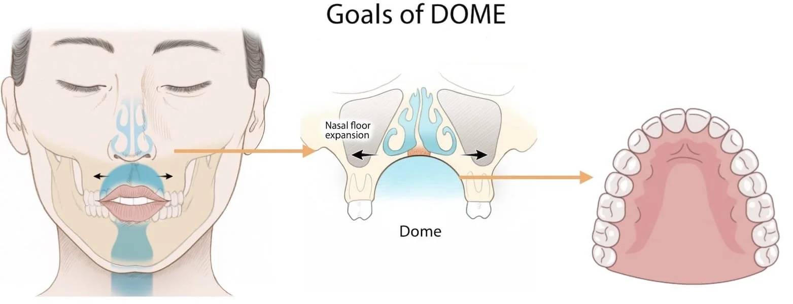 Visualization of the goals of DOME treatment – improved nasal breathing and widened palatal arch