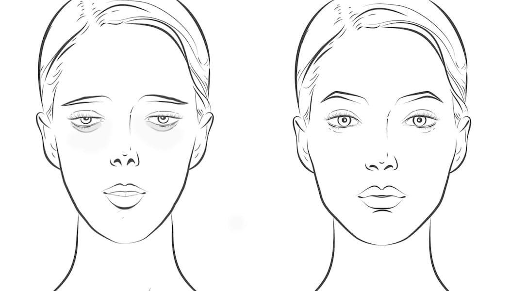 Illustration der Gesichtsentwicklung vor und nach Kiefererweiterung. Fokus auf Ästhetik und Symmetrie