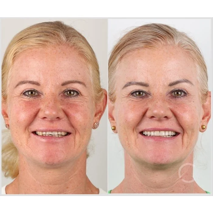 Vorher-Nachher-Foto einer erwachsenen Patientin mit sichtbar verbessertem Lächeln nach kieferorthopädischer Behandlung