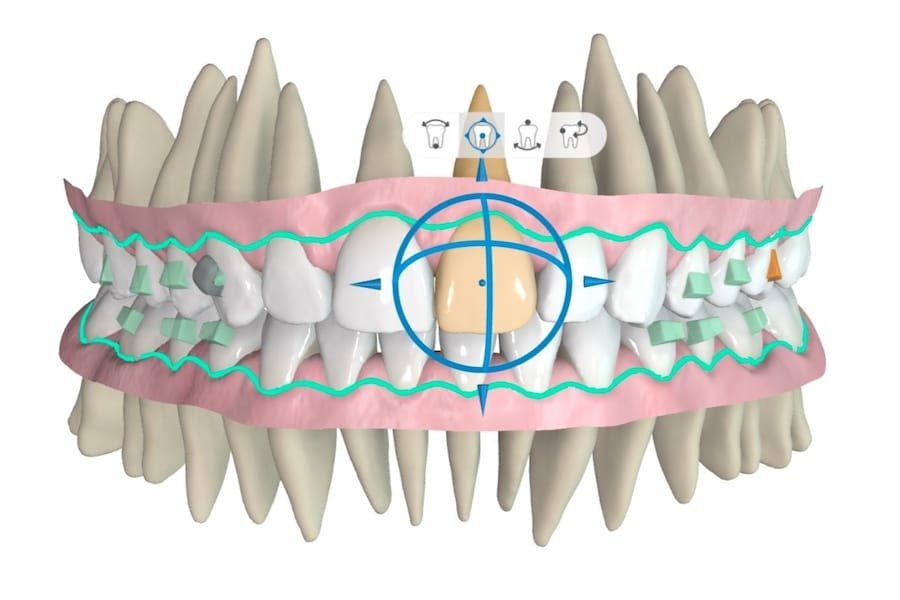 3D-Darstellung der Zahnstellung zur digitalen Planung einer Aligner-Therapie