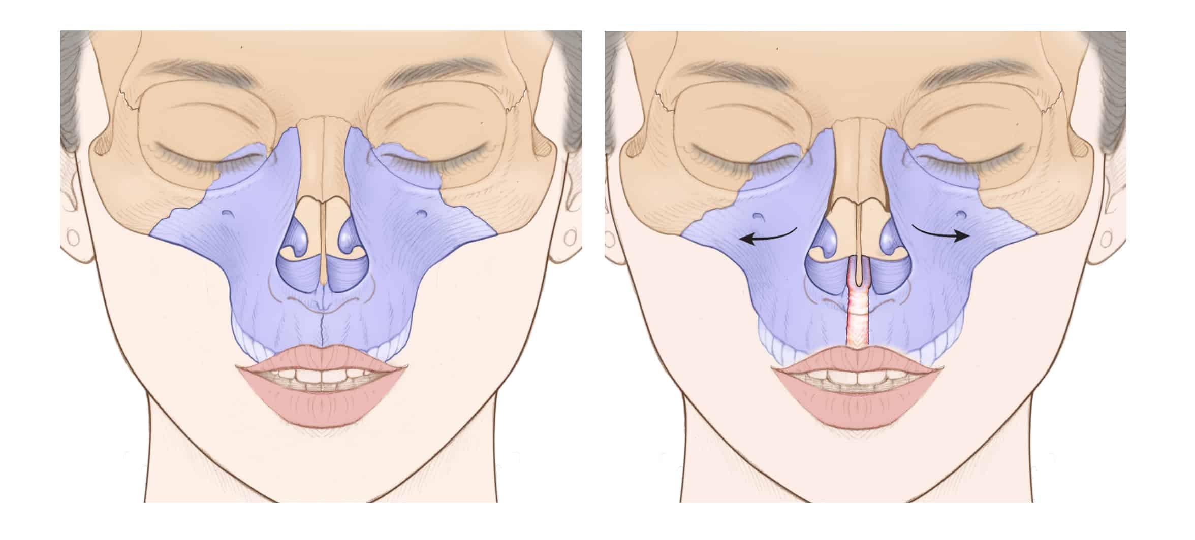 DOMEzero wides nasal cavity