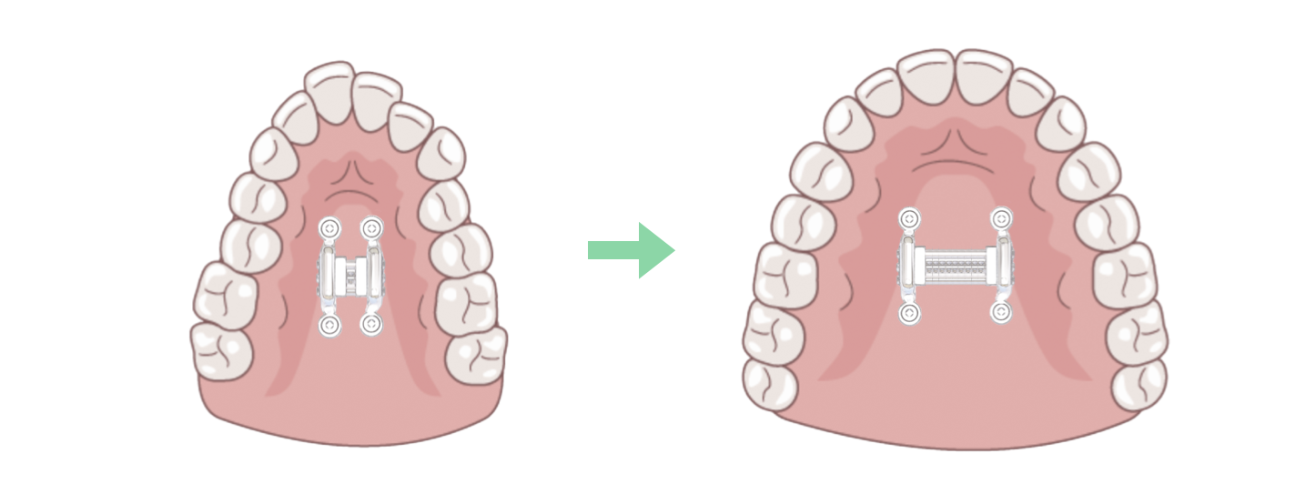 Skeletal Expansion of the Maxilla