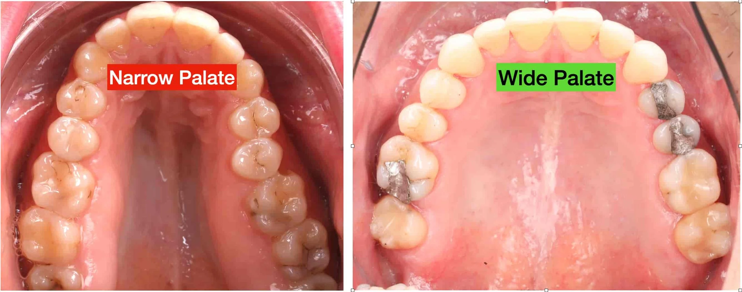 narrow palate vs wide palate picture