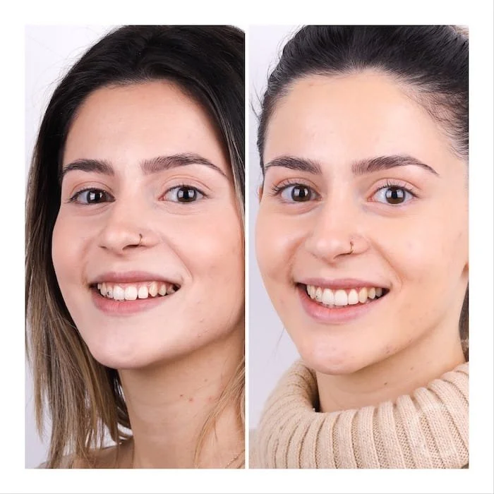 Vorher-Nachher-Bild einer jungen Patientin mit verbessertem Zahnbogen und Lächeln nach der Behandlung