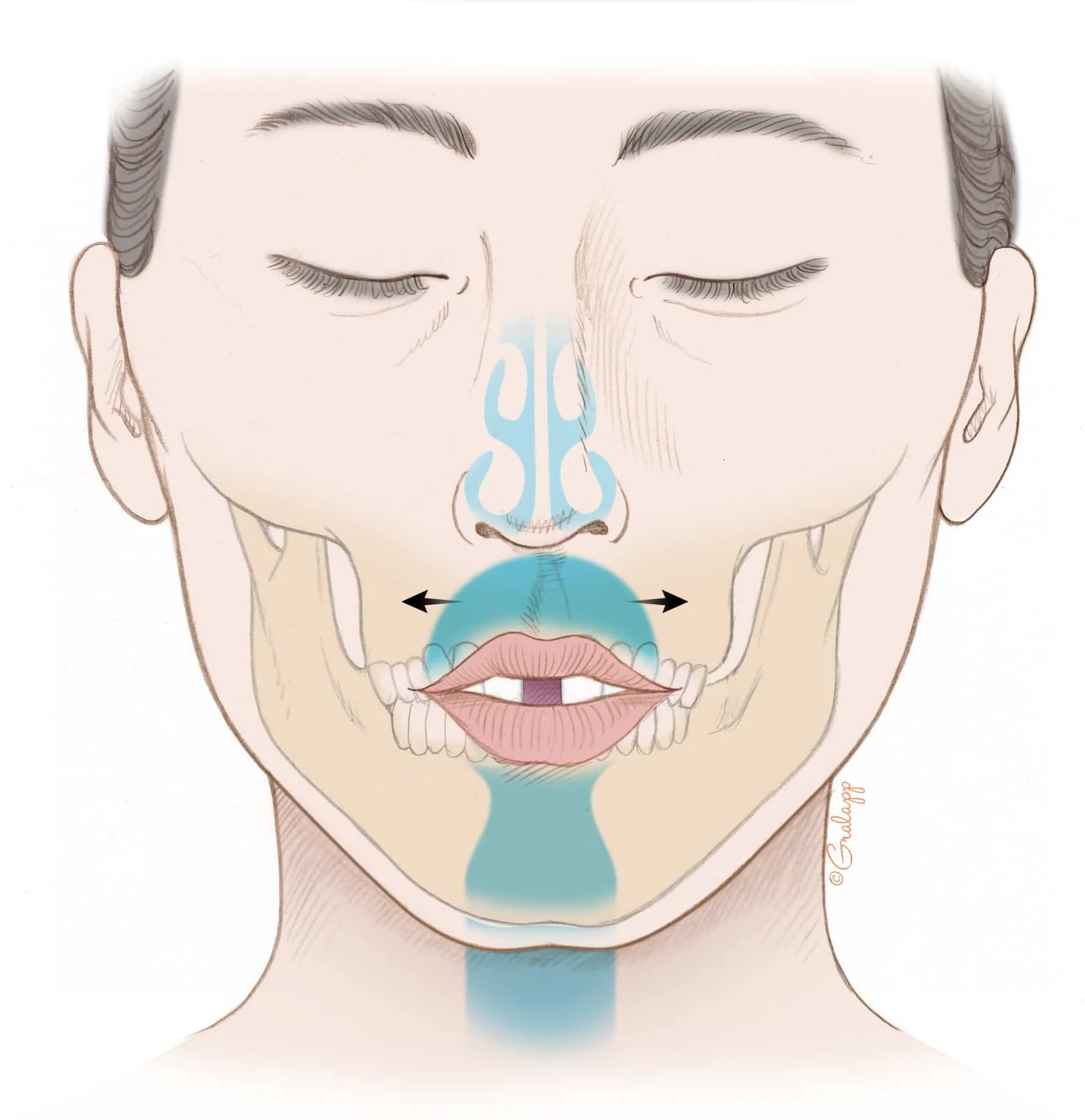 wide gap after MARPE expansion