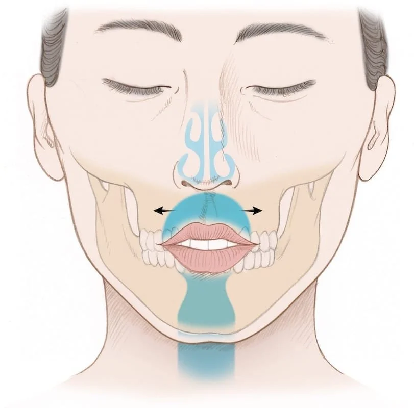 Illustration showing the effect of DOME on palate widening and upper airway improvement