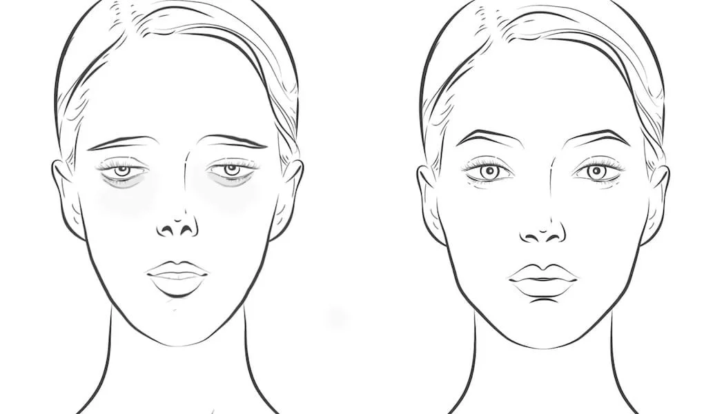 Illustration of facial transformation before and after maxillary expansion – enhanced symmetry and aesthetics