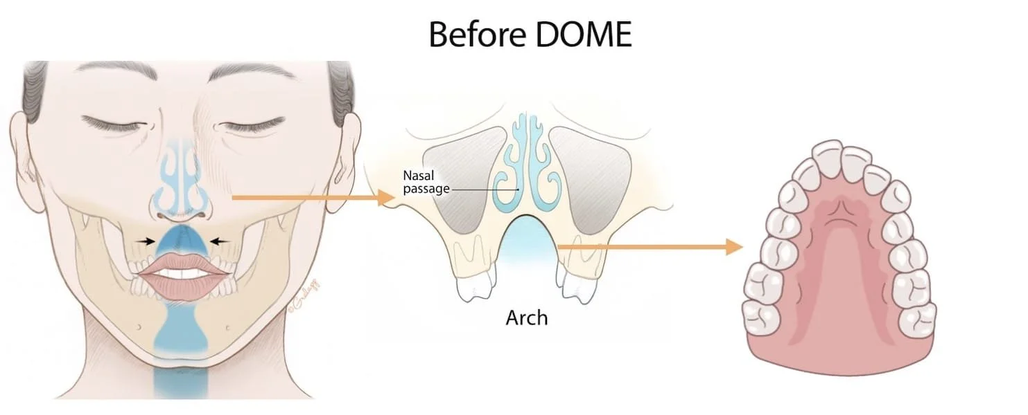 Anatomical illustration showing restricted nasal airflow and narrow arch before DOME treatment