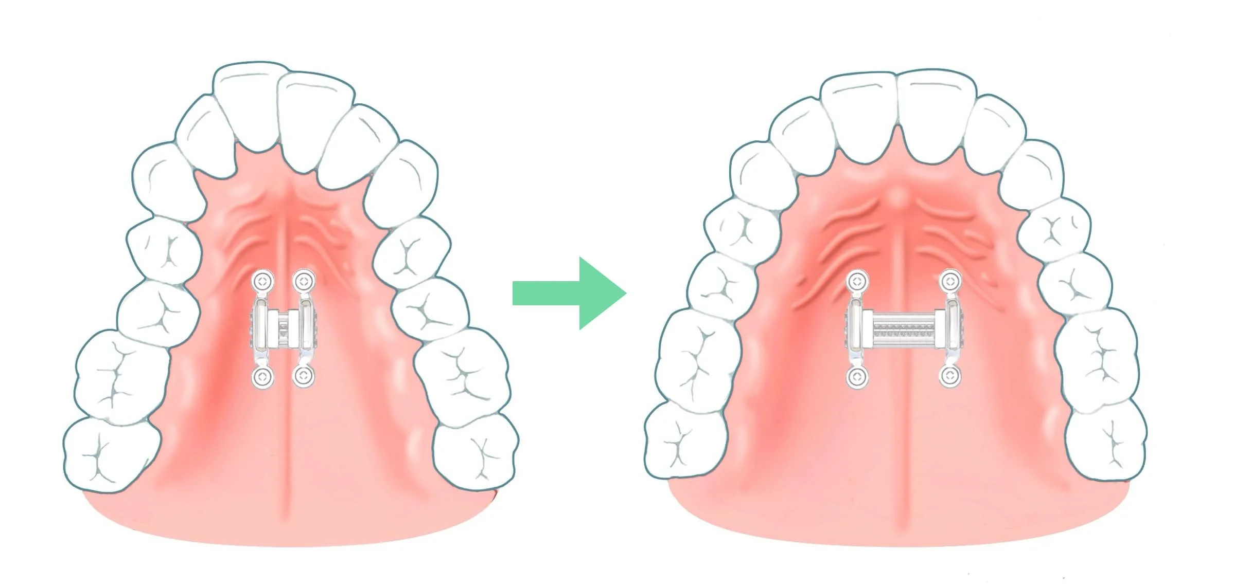 DOMEzero illustration growing jaws in adults