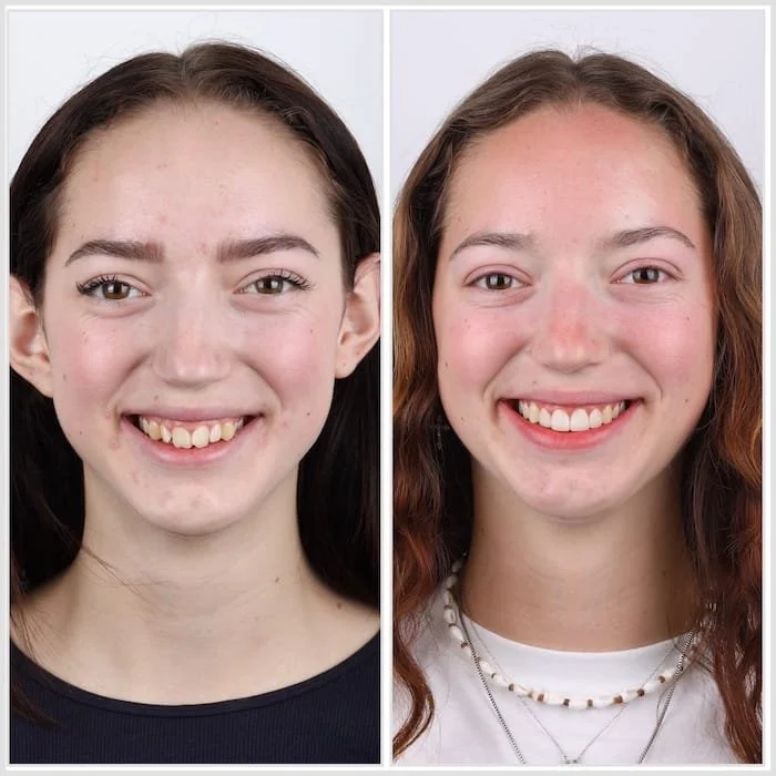 Jugendliche Patientin mit deutlicher Verbesserung der Zahnstellung nach kieferorthopädischer Behandlung