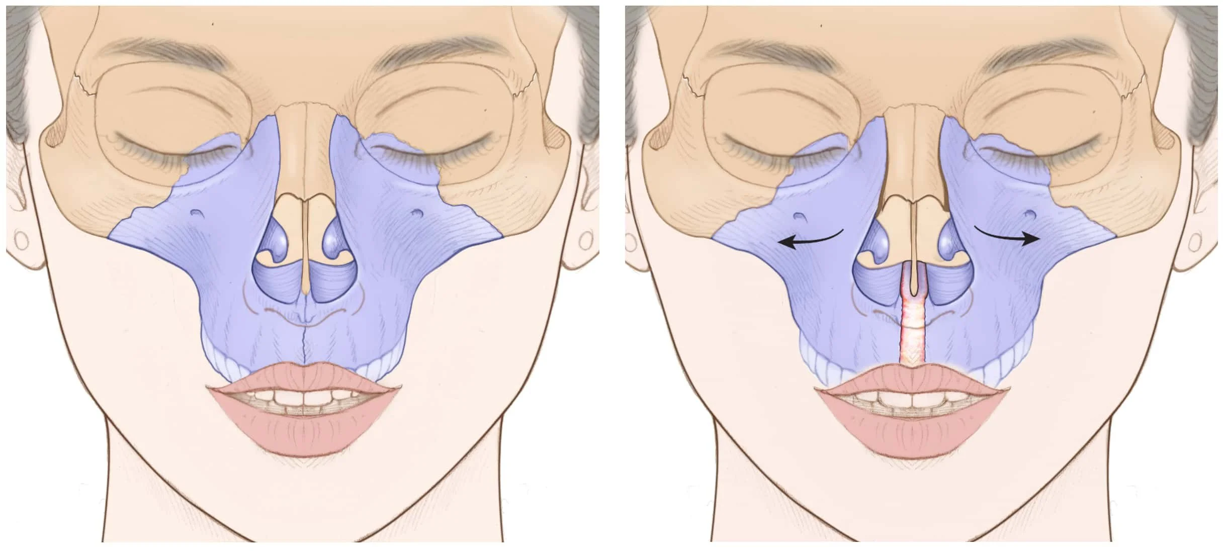 DOMEzero , Expansion zero gap