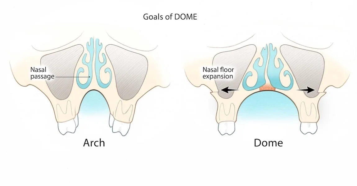 Anatomischer Vergleich vor und nach DOME - Erweiterung des Nasenbodens