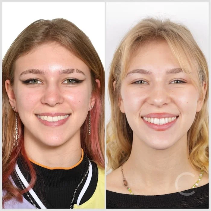 Transformation des Lächelns einer Jugendlichen mit natürlicher und harmonischer Zahnstellung