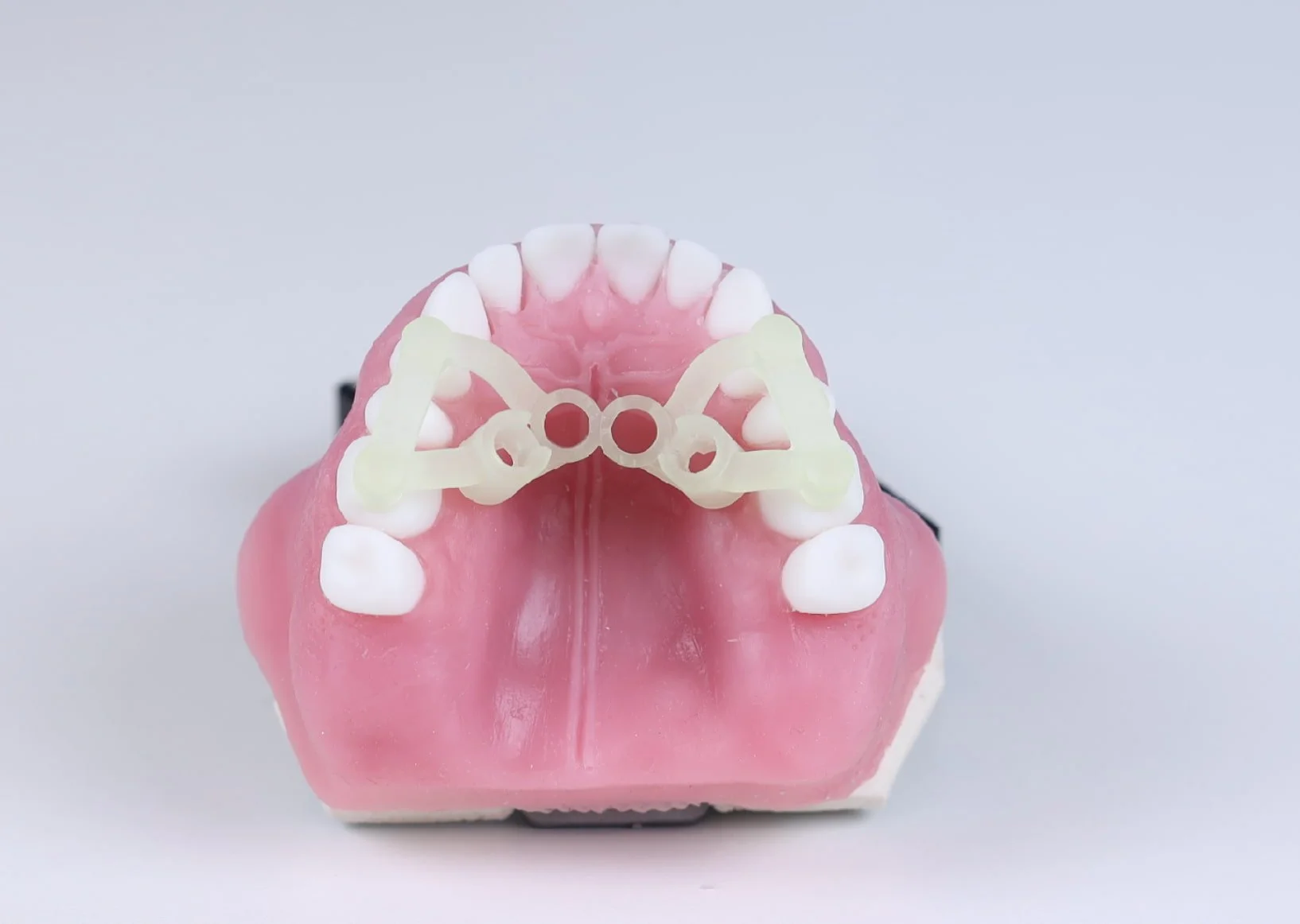 Führungsschablonen für genau Mini-Implantat-Setzung