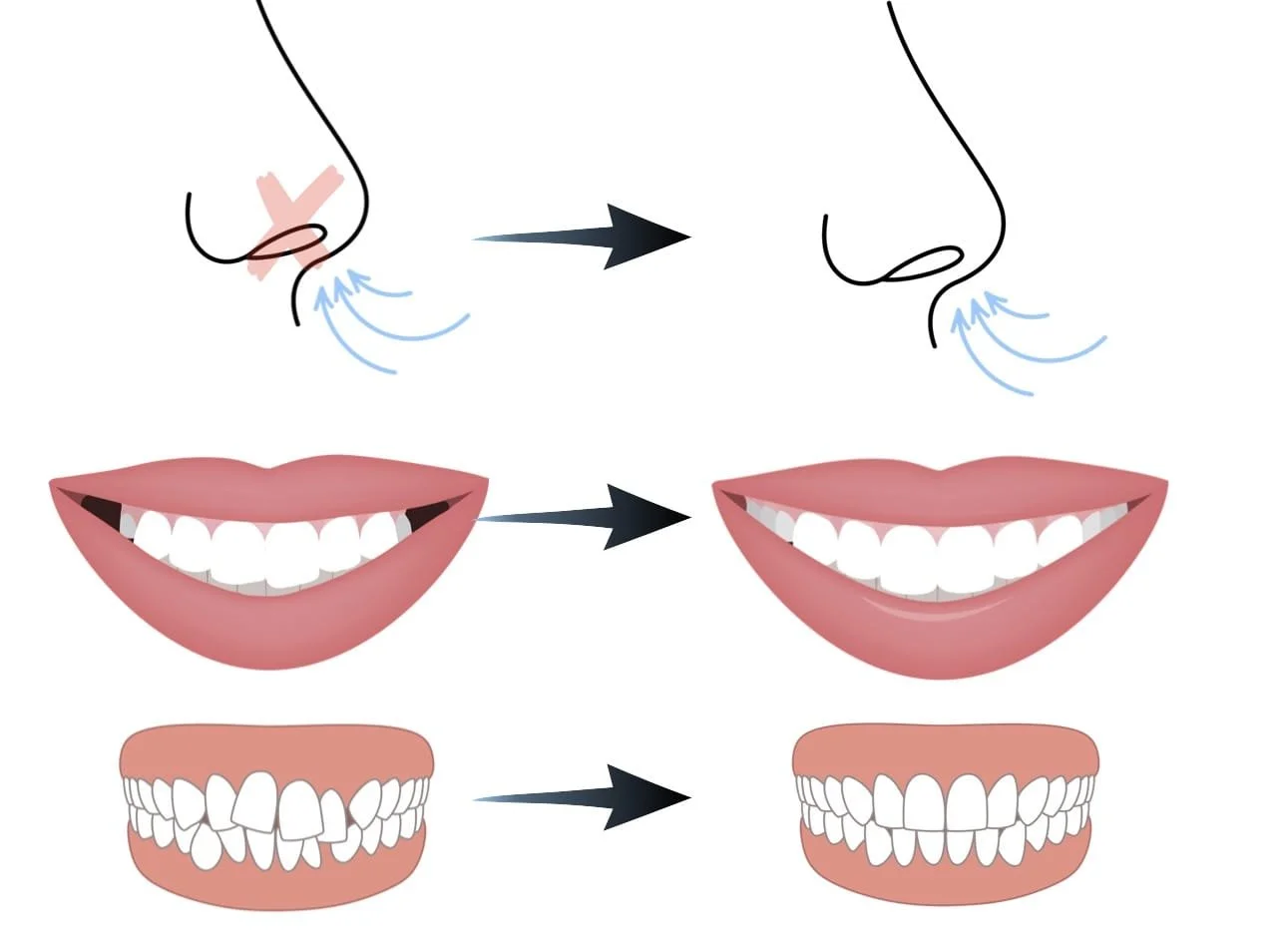 Illustration of DOME therapy benefits – better breathing, wider smile, and aligned teeth