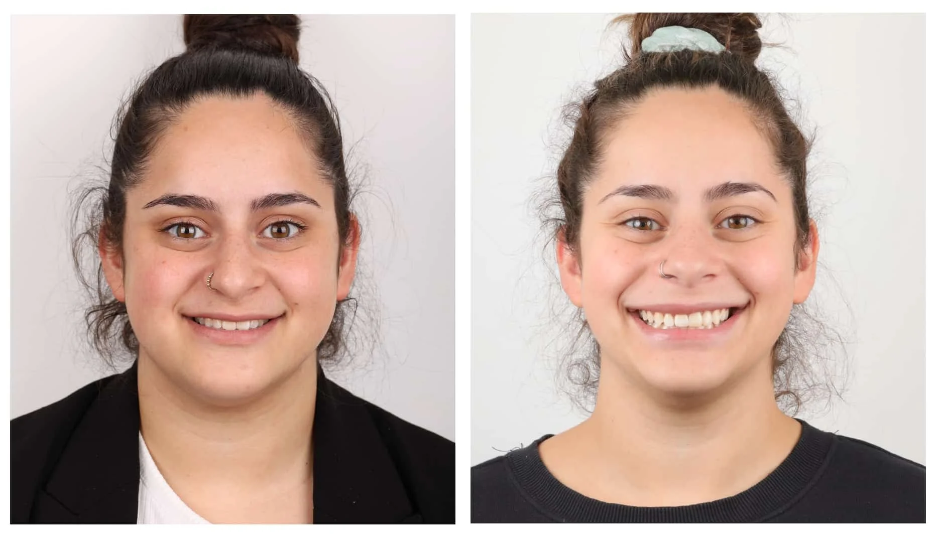 DOMEzero before and after: wider smile, improved breathing