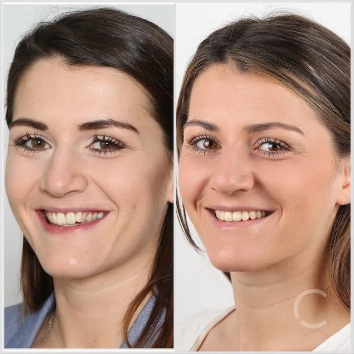 Vorher-Nachher-Bild einer jungen Frau mit optimierter Zahnstellung und verändertem Gesichtsprofil