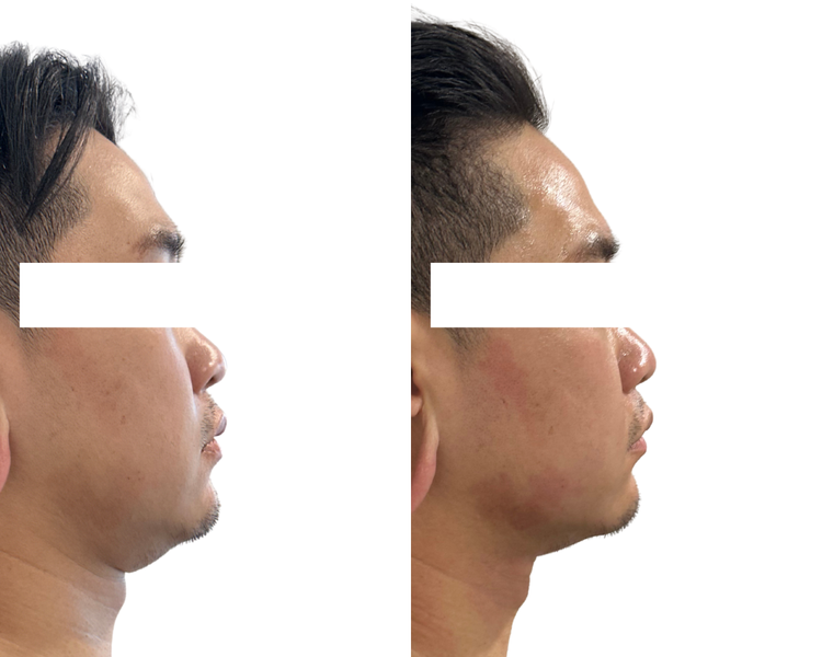 Face Fit Tox before and after, jawline contouring Auckland