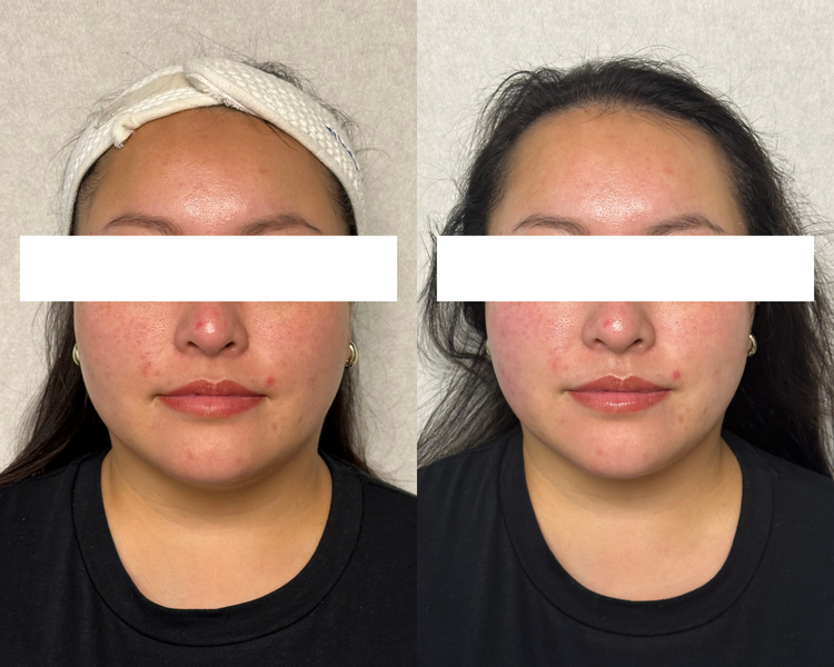 Face Fit Tox before and after, skin volume restoration Urban Beauty