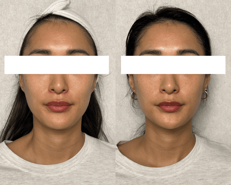 Face Fit Tox before and after, facial lifting results Auckland CBD