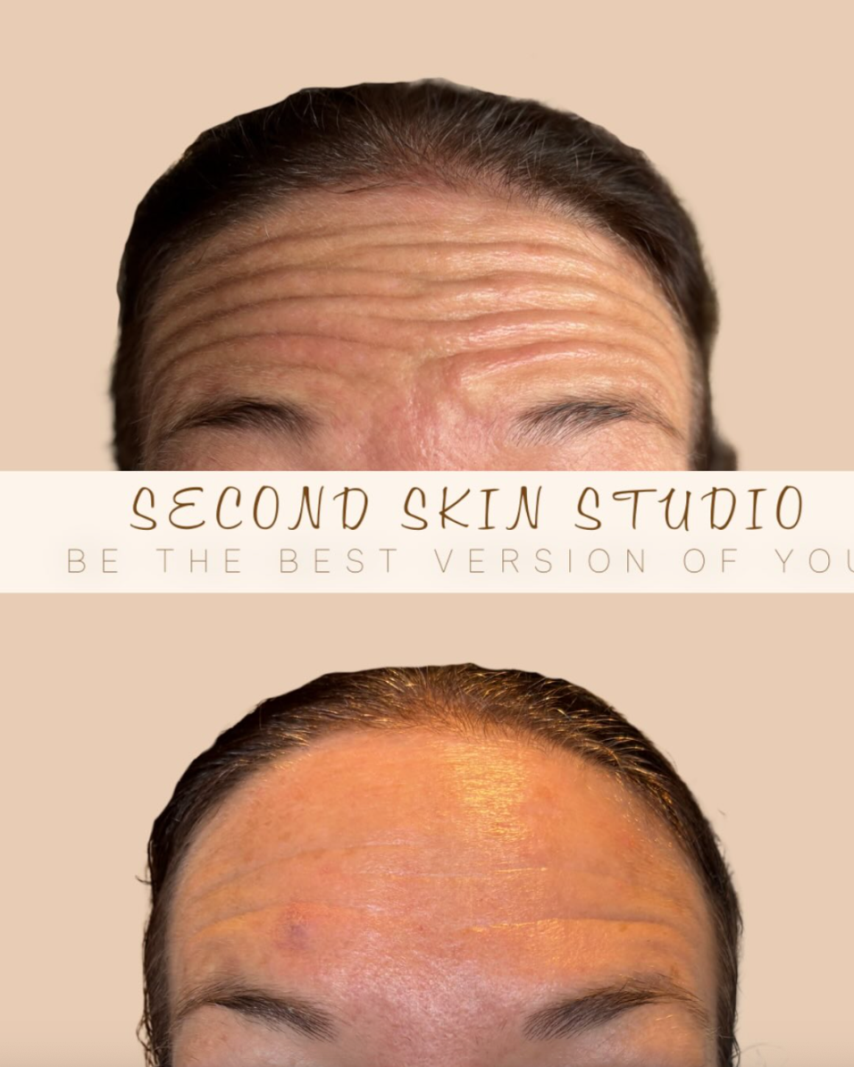 Before and after images of a person with improved skin appearance from Second Skin Studio, showing reduction in forehead wrinkles and smoother skin.