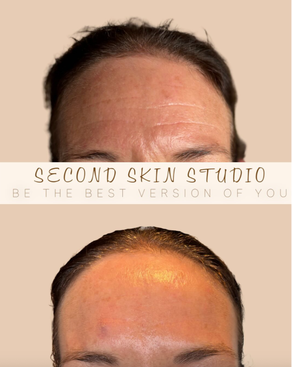 Comparison of a man's forehead before and after skincare treatment, with text branding for Second Skin Studio and a tagline to be the best version of yourself.