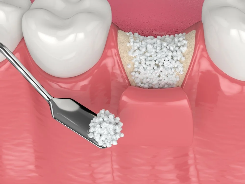 Illustration of a dental bone graft procedure with synthetic granules being placed in a tooth socket.