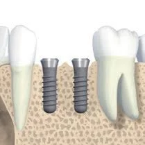 Diagram showing dental implants and natural teeth in jawbone