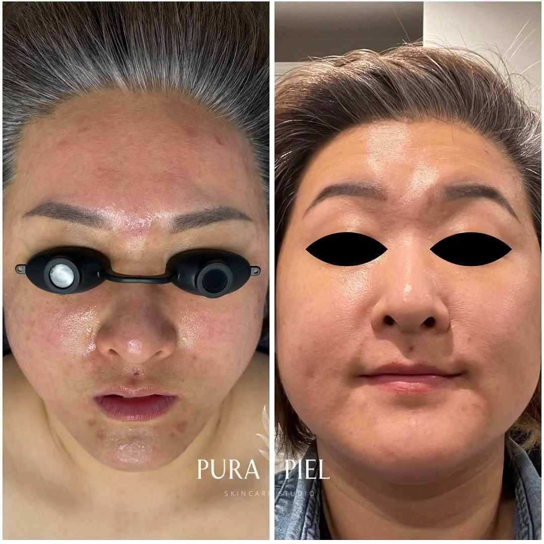 Same day before and after picture &mdash; post. Nano needling &amp; Co2 Pro lift treatment mask. 
.
.
#skincare #skinjourney #skin #dmvfacials #facials