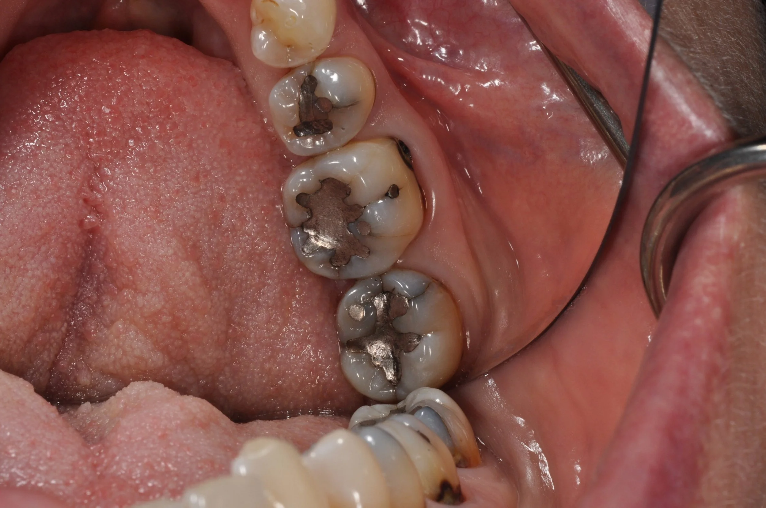 Mercury Fillings Before 3 Kaufman Dental.JPG