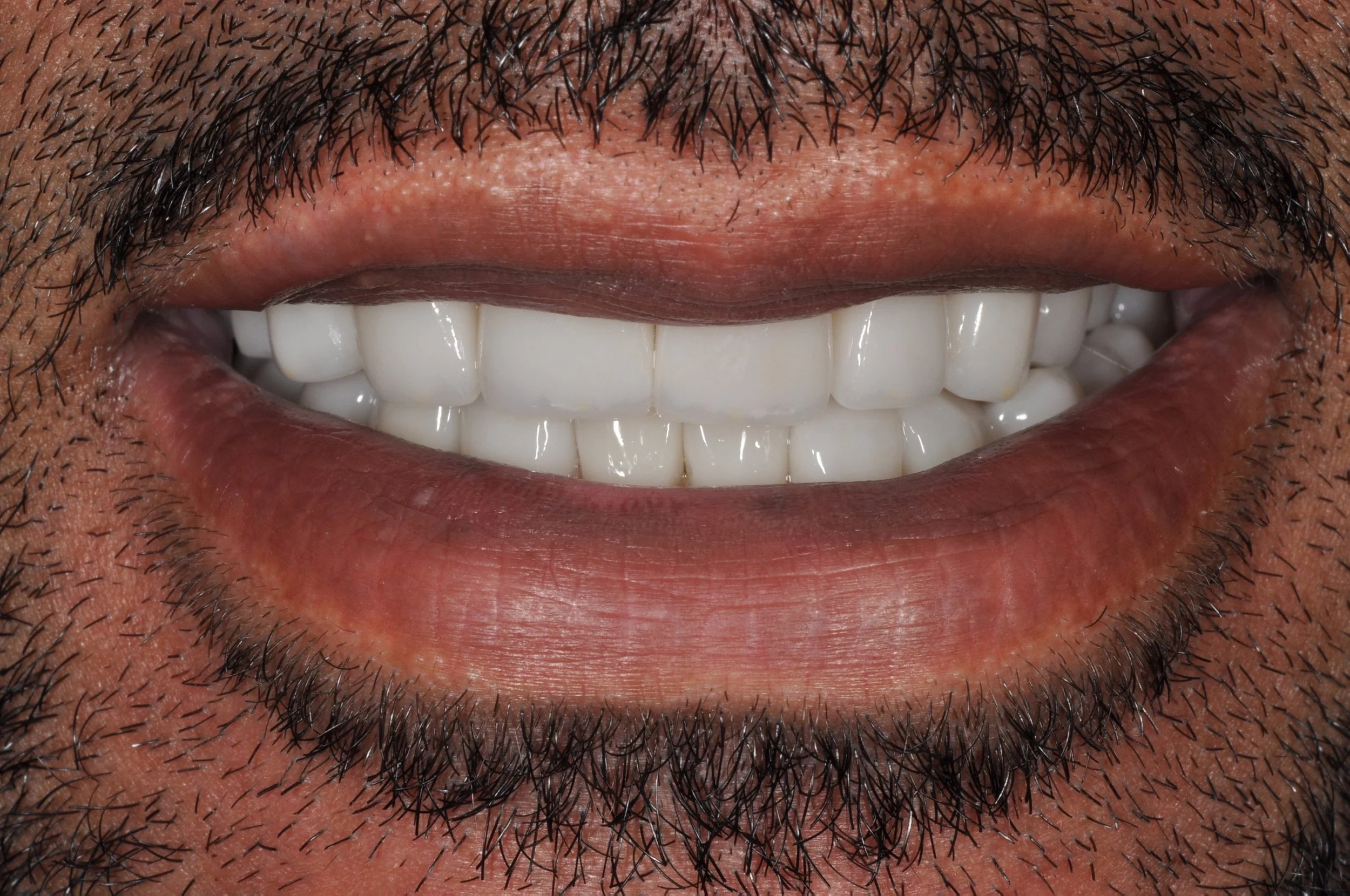 Veneers Kaufman Dental 2m After.JPG