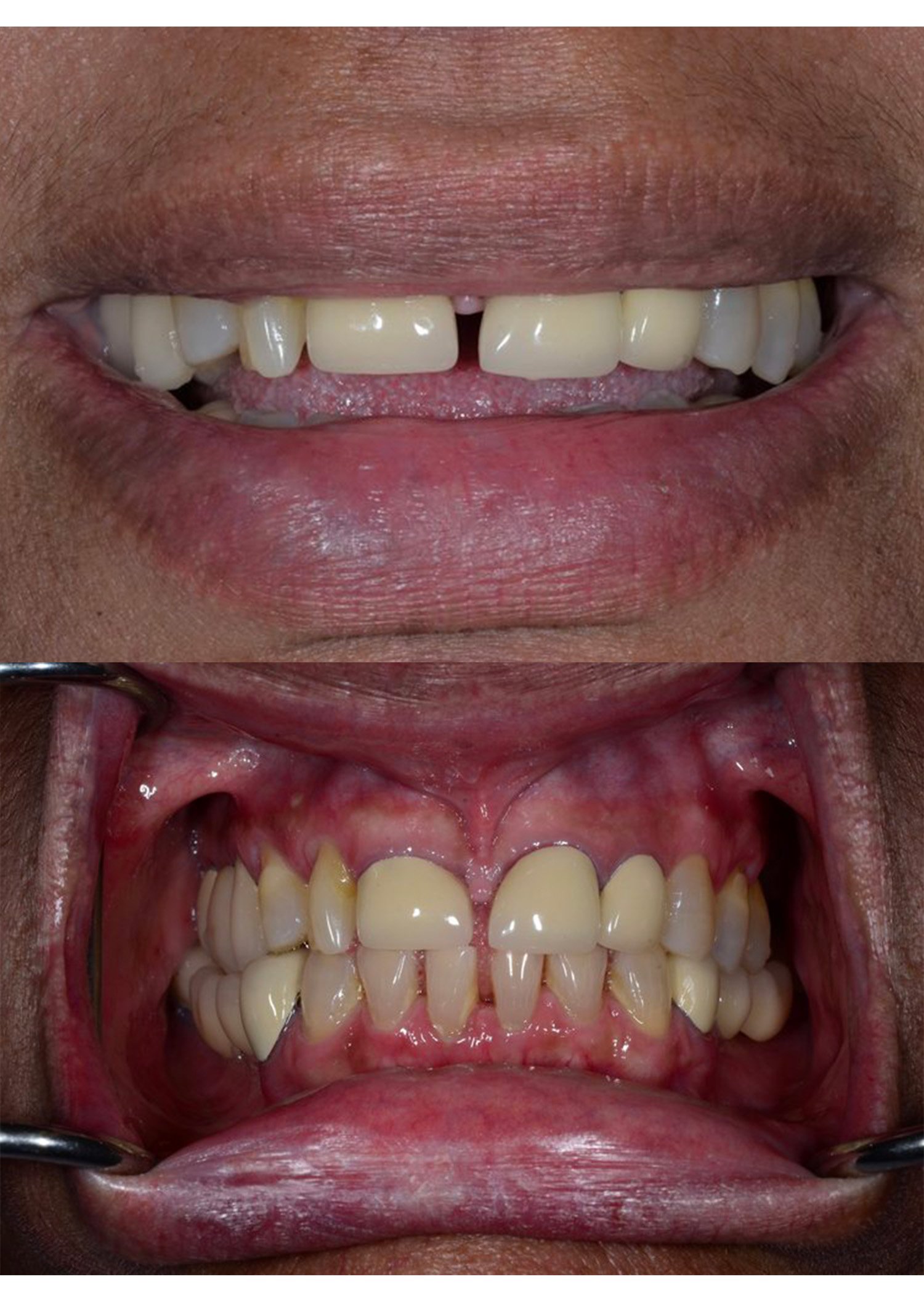 Two close-up photos of a complete neuromuscular case: before treatment (top) showing misaligned teeth and after treatment (bottom) displaying a balanced, restored smile