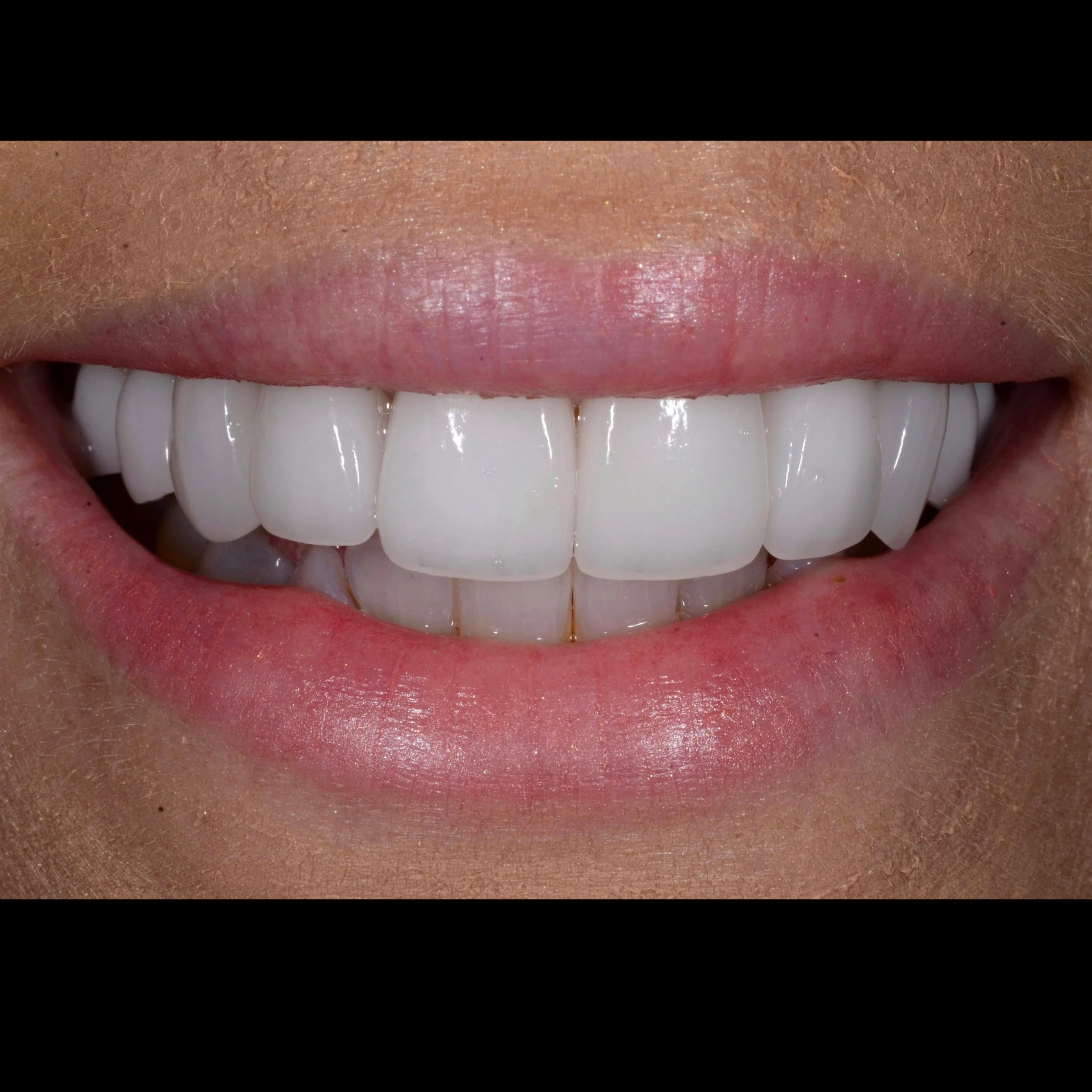 Veneers Kaufman Dental 2m After.1.JPG