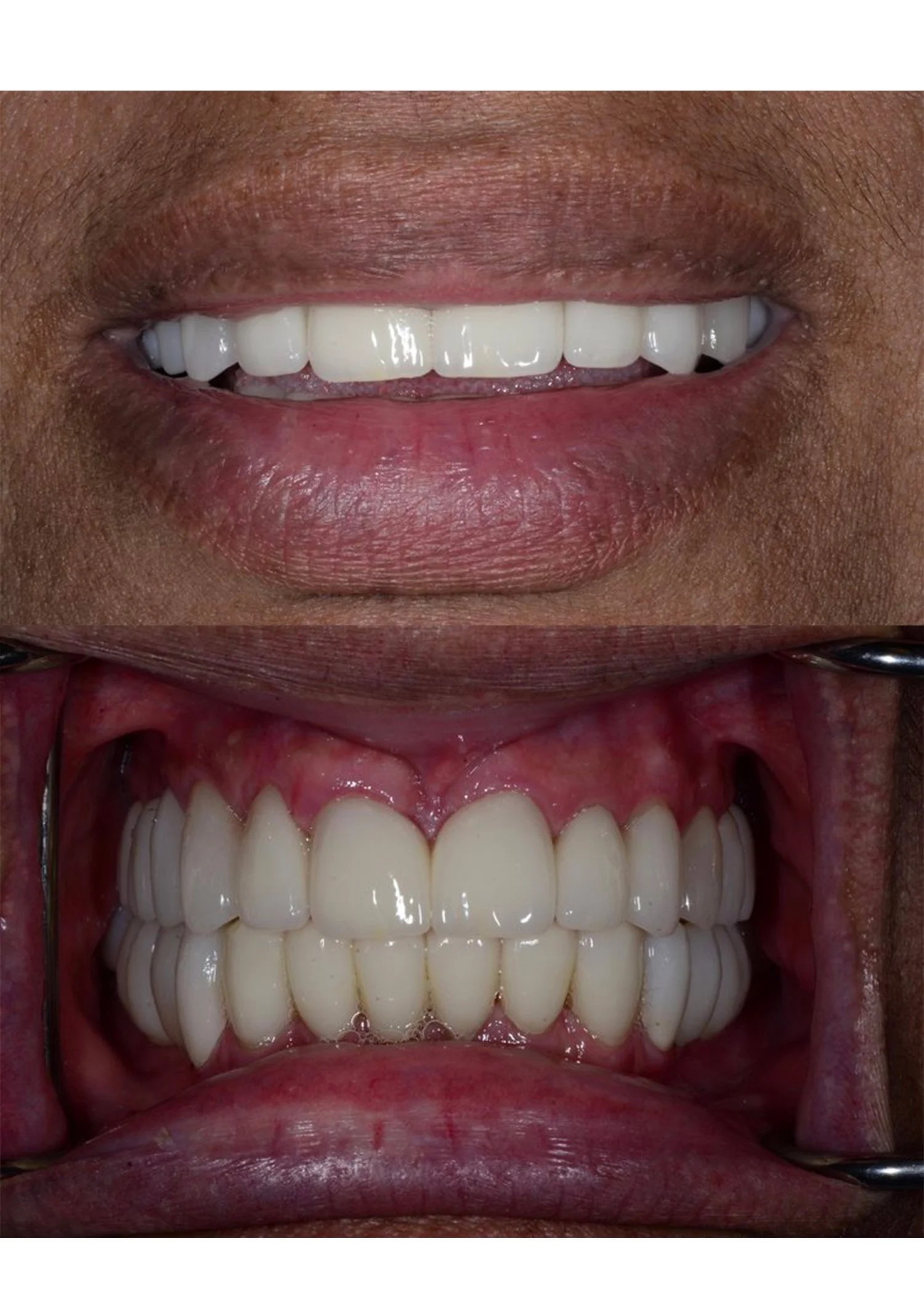 Close-up photos of a neuromuscular case: top image shows pre-treatment misalignment, bottom image reveals post-treatment with a balanced, healthy smile.