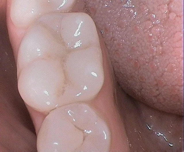 Mercury Fillings After 2.JPG