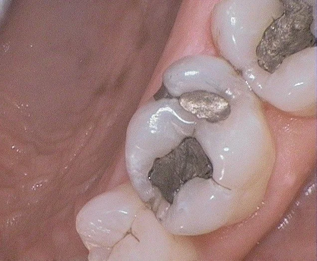 Mercury Fillings Before 1.JPG
