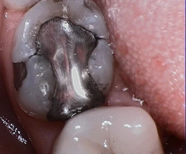 Mercury Filllings Before 2.JPG