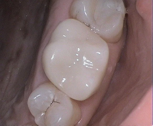 Mercury Fillings After 1.JPG