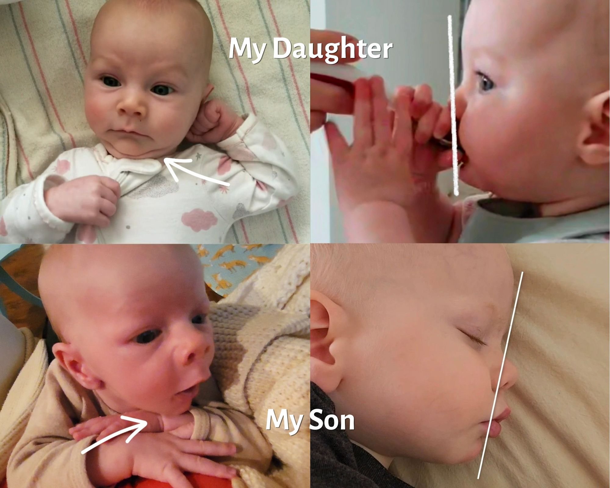 Recessed Chin - How I Helped My Baby’s Jaw Come Forward